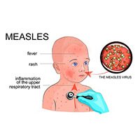 measles